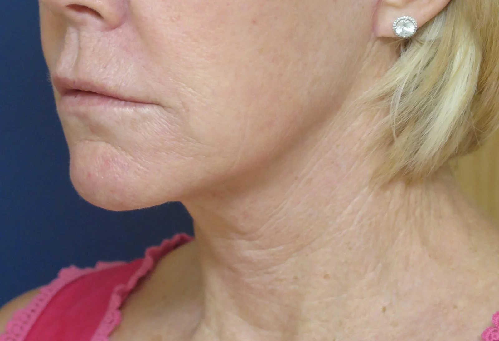 Patient picture after neck lift at Nuance Facial Plastics
