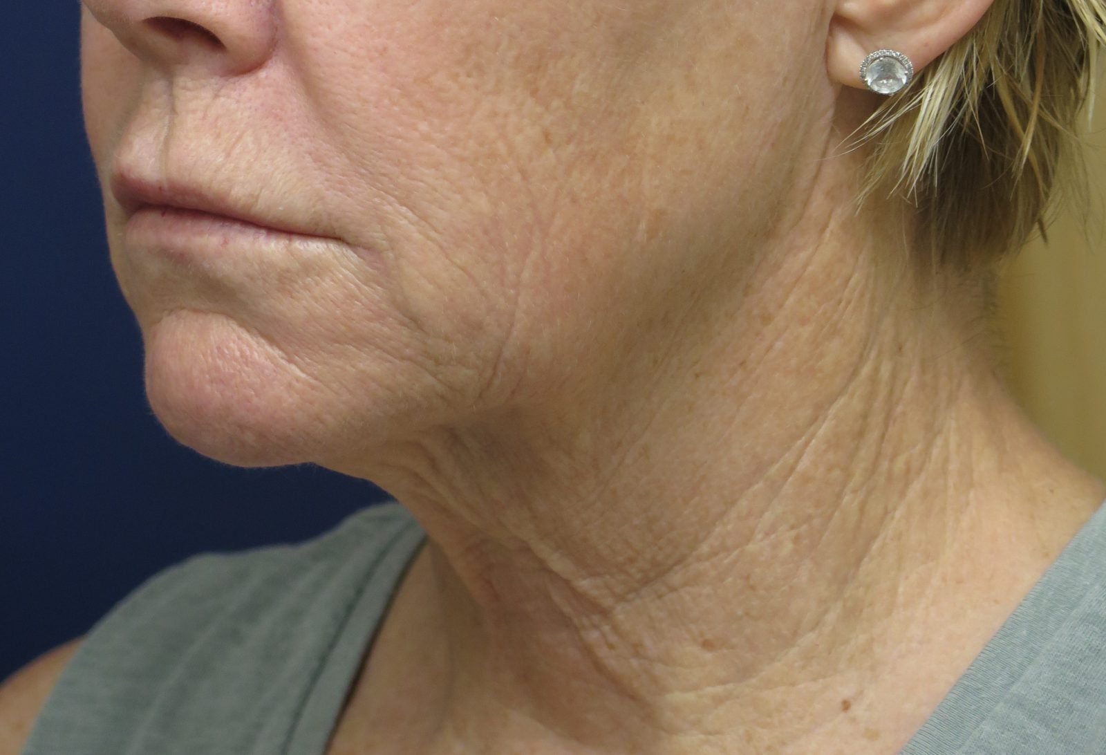 Patient picture after neck lift at Nuance Facial Plastics