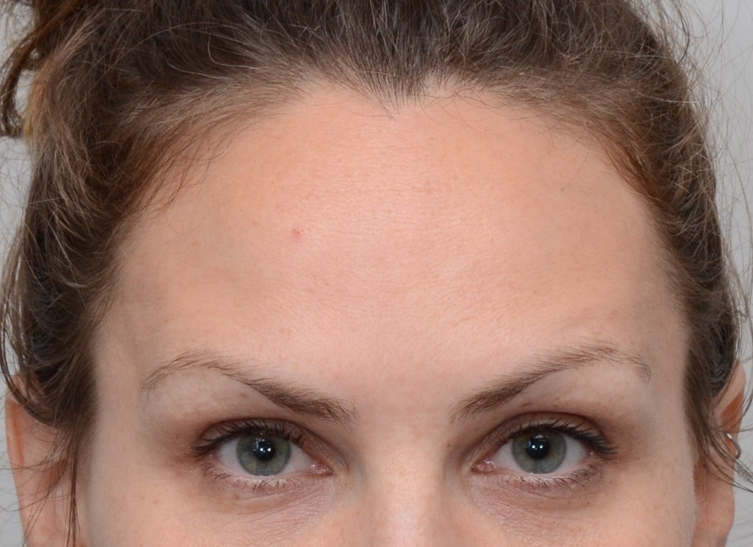 Patient picture after Botox at Nuance Facial Plastics