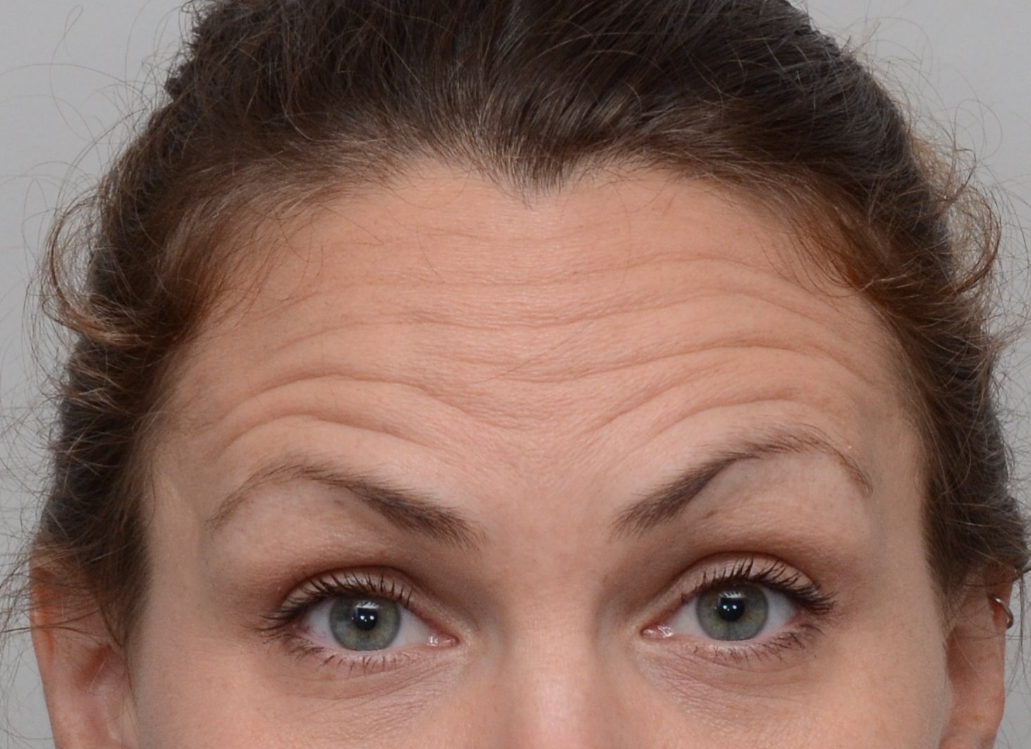 Patient picture after Botox at Nuance Facial Plastics