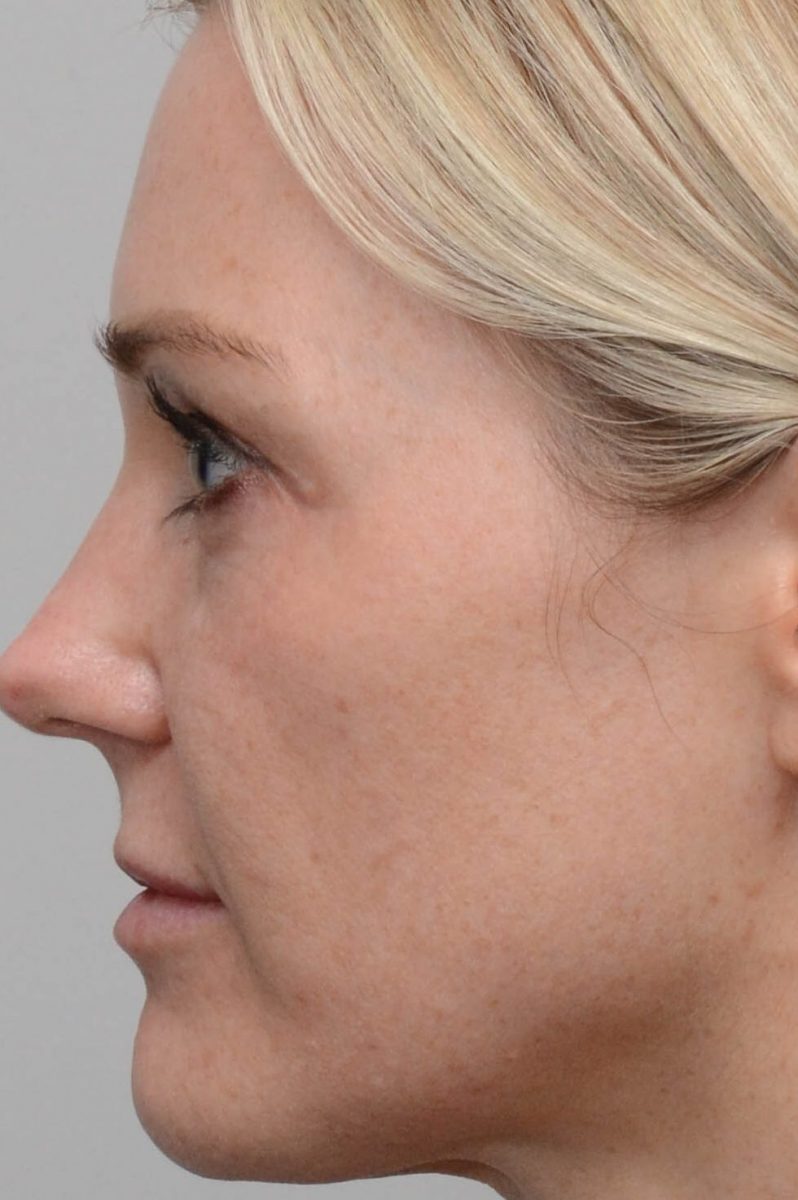 Patient after fractional erbium laser skin resurfacing at Nuance Facial Plastics
