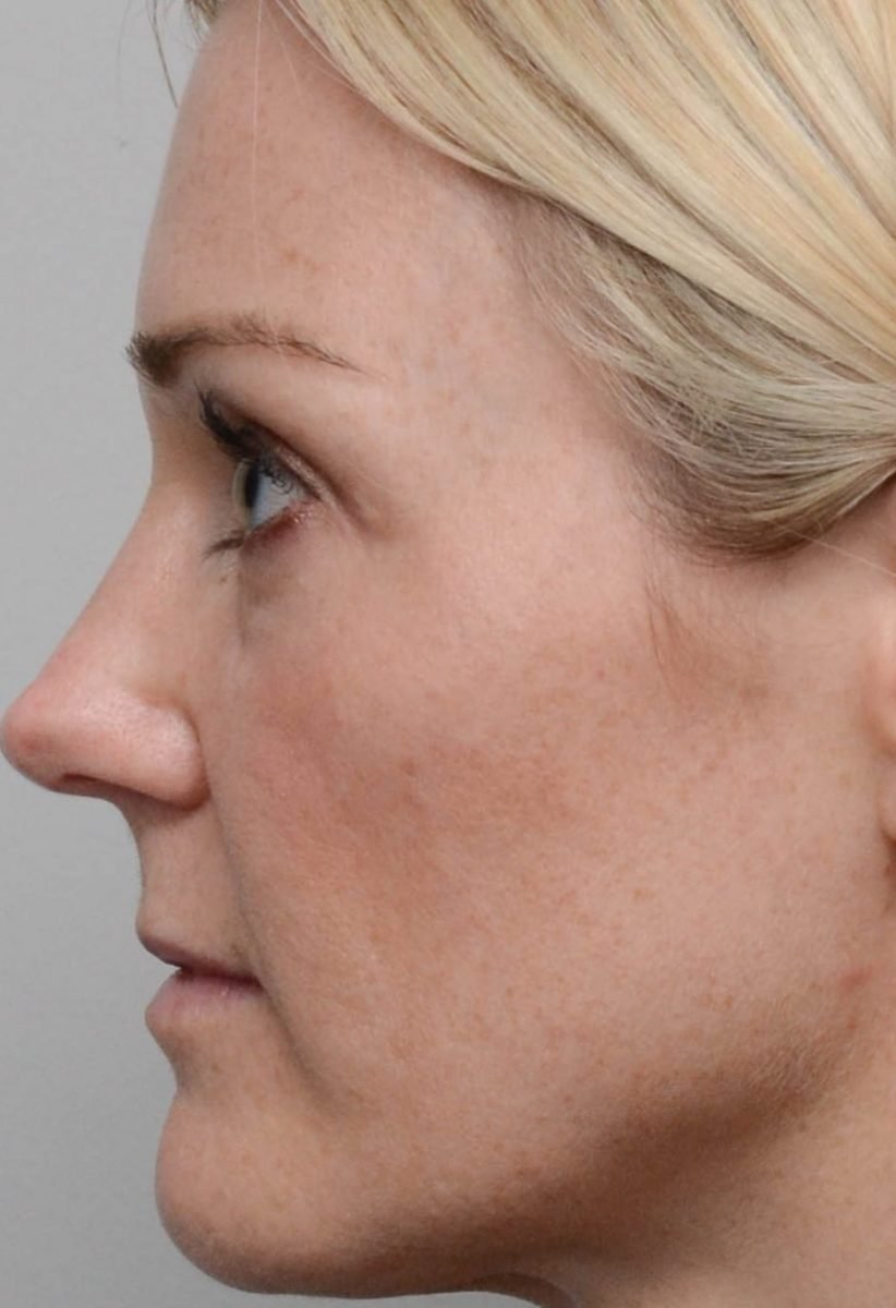 Patient after fractional erbium laser skin resurfacing at Nuance Facial Plastics