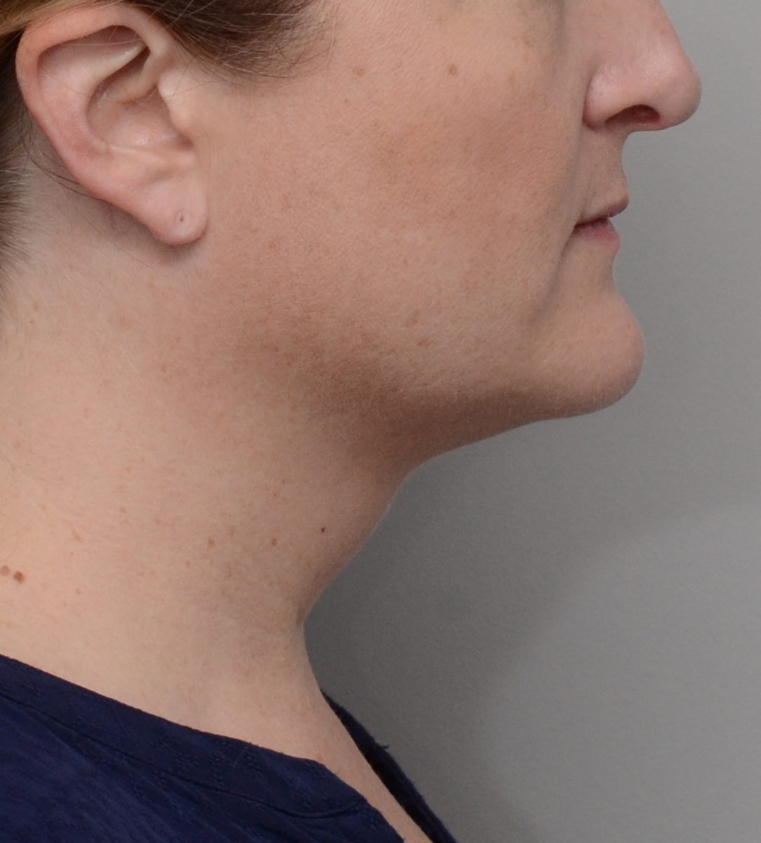 Patient picture after Kybella at Nuance Facial Plastics