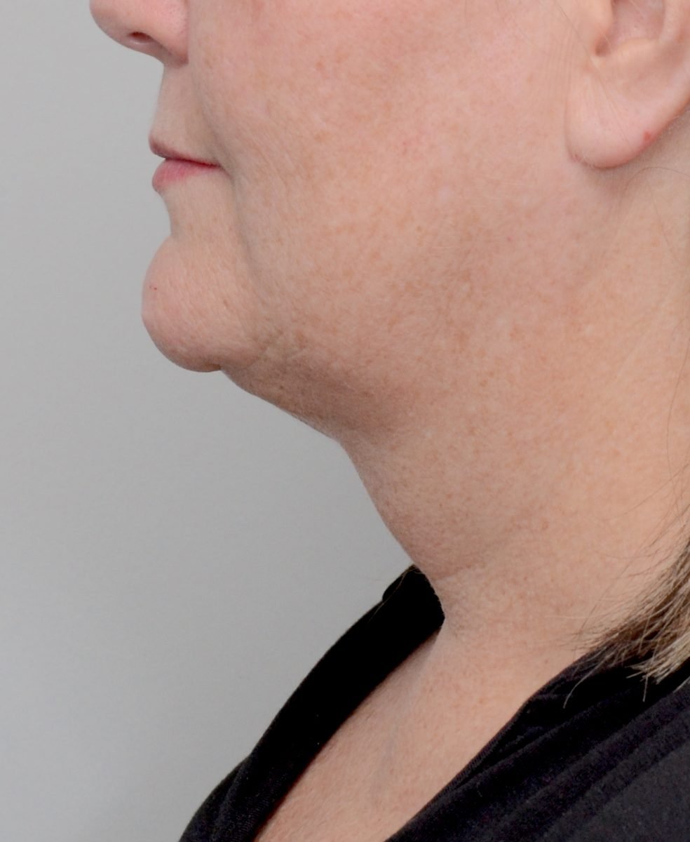 Patient picture after chin and neck liposuction at Nuance Facial Plastics