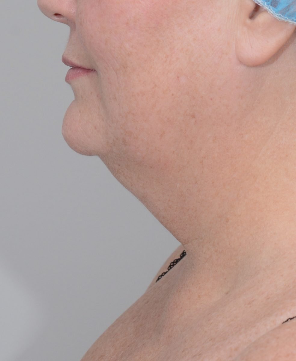 Patient picture after chin and neck liposuction at Nuance Facial Plastics
