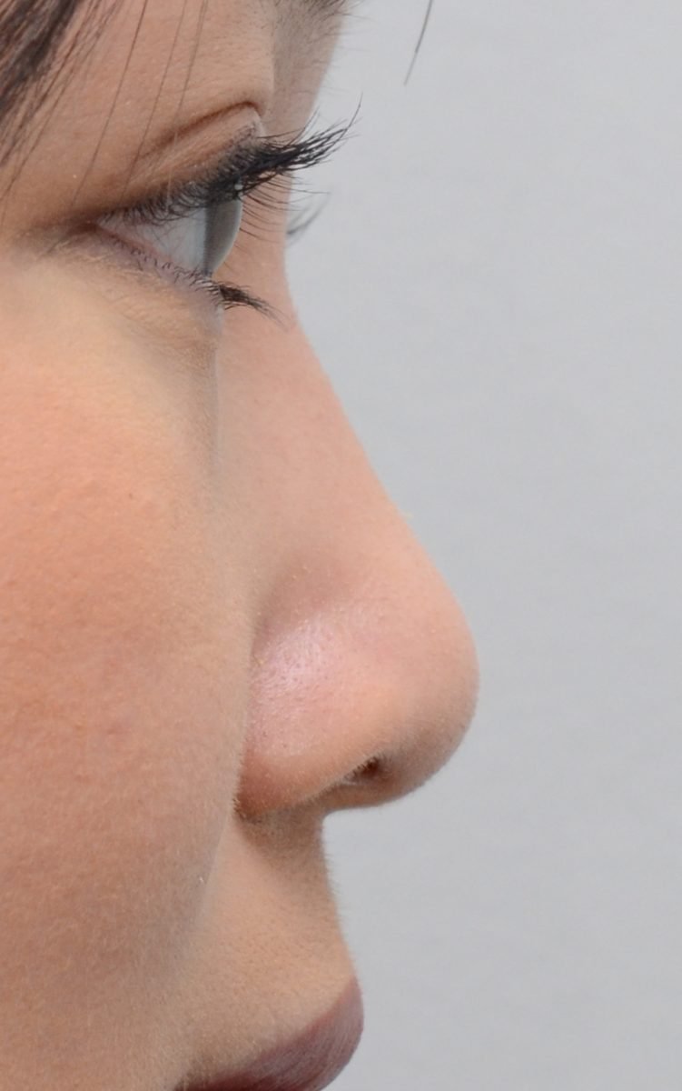 patient picture after non surgical rhinoplasty bridge