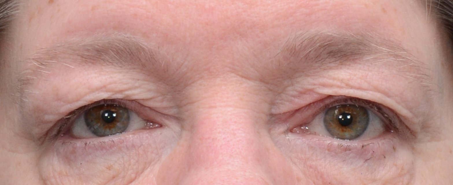 patient picture after upper eyelid lift blepharoplasty