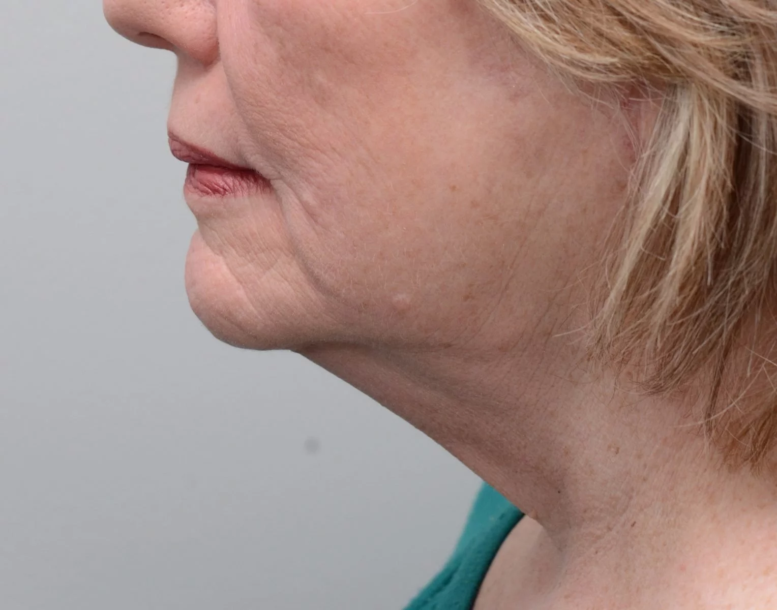 Picture of patient after neck lift surgery