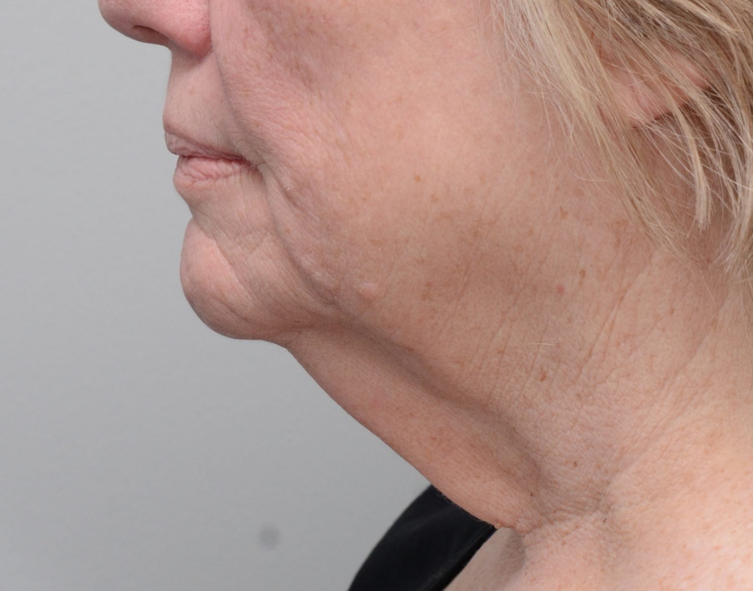 Picture of patient after neck lift surgery