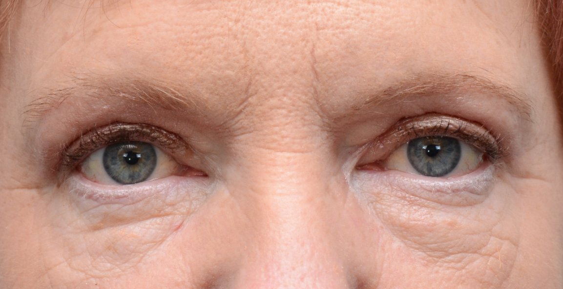 Patient picture after upper eyelid lift blepharoplasty