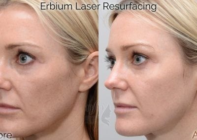 fractional erbium laser before and after