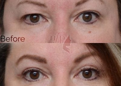 Before and after eyelid lift