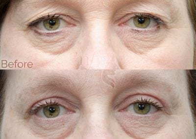 Before and after eyelid lift
