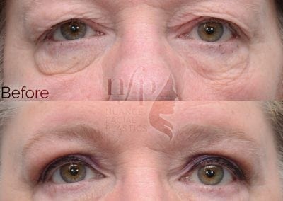 Before and After Eyelid Lift