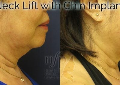 before and after neck lift chin implant
