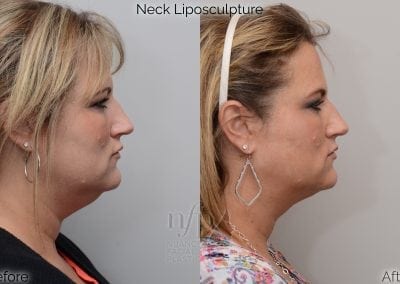 before and after neck liposuction