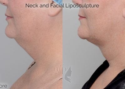 before and after neck liposuction