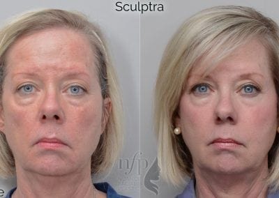 before and after sculptra
