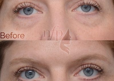 Before and after tear trough filler