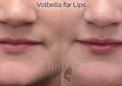 before and after volbella lips