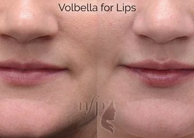 before and after volbella lips