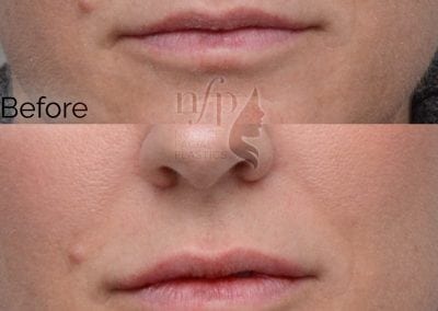 Volbella is a great product for lasting volume in the lips. As seen here, a "dehydrated" look can be converted into a "plump" look while keeping the results natural appearing.