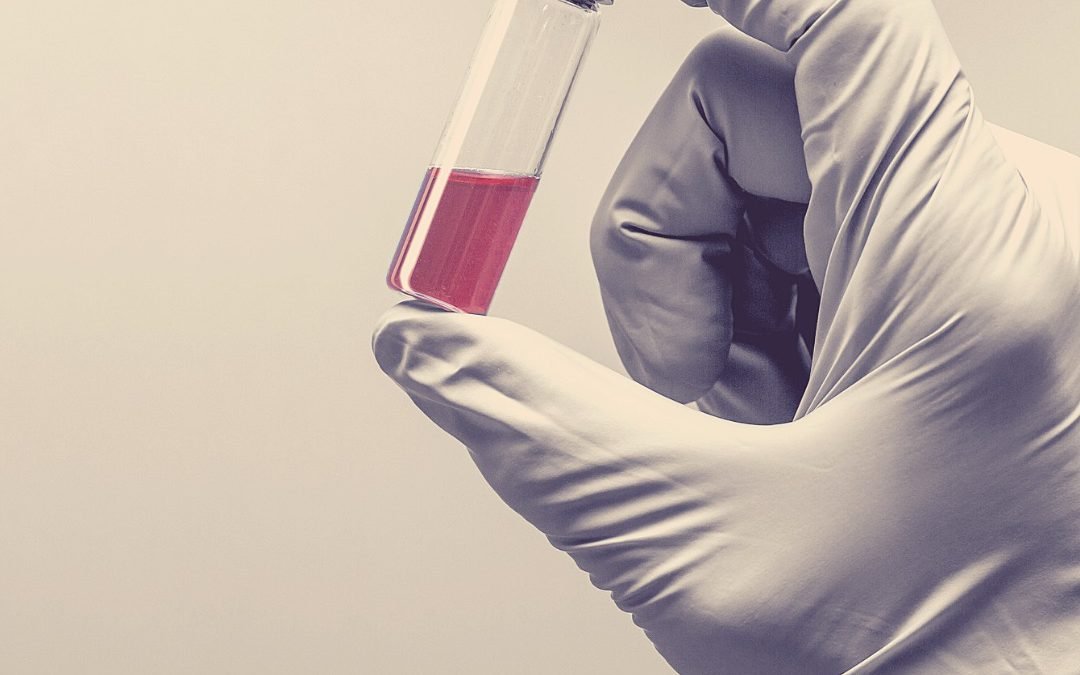 Vampire Facials – My Experience with PRP Facials