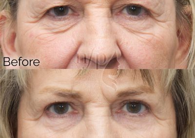 front view upper and lower eyelid lift