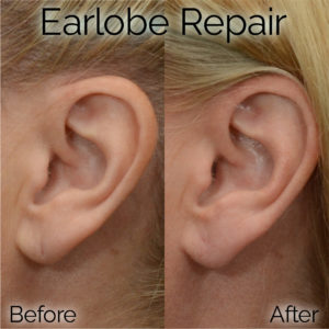 elongated earlobe repair patient