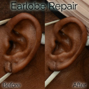 Patient before and after repair of her torn earlobe
